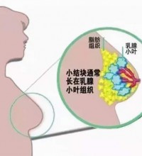 乳腺肿瘤补硒是关键，硒是妇科疾病的克星